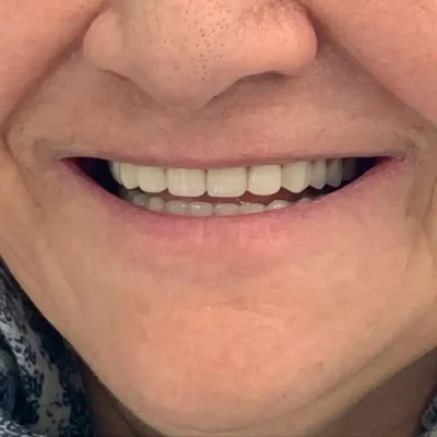 نتیجه نهایی و لبخند زیبای بیمار پس از کاشت دندان با قیمت مناسب در کلینیک دکتر رئوف تبریز