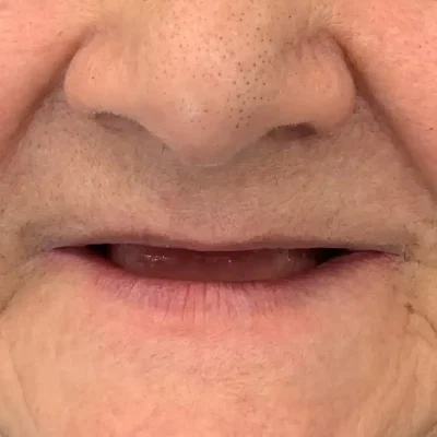 وضعیت دندان بیمار قبل از شروع درمان برای برآورد هزینه ایمپلنت دندان در تبریز